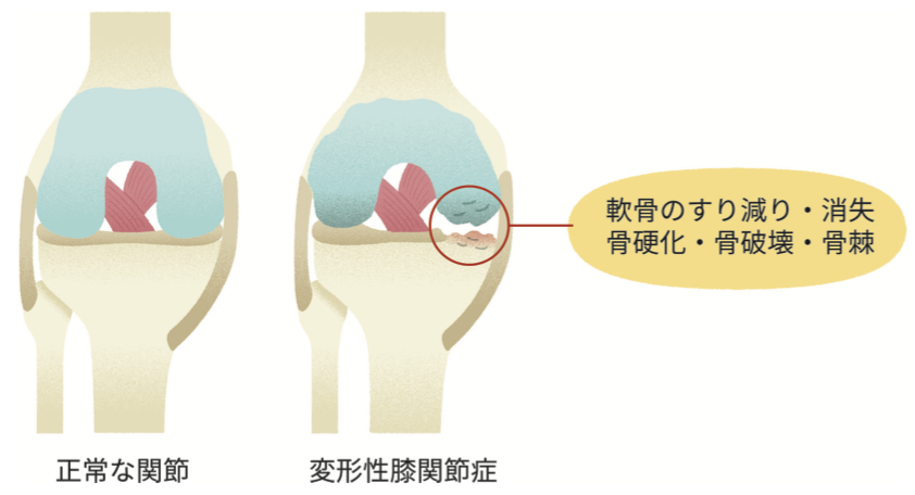 変形性関節症